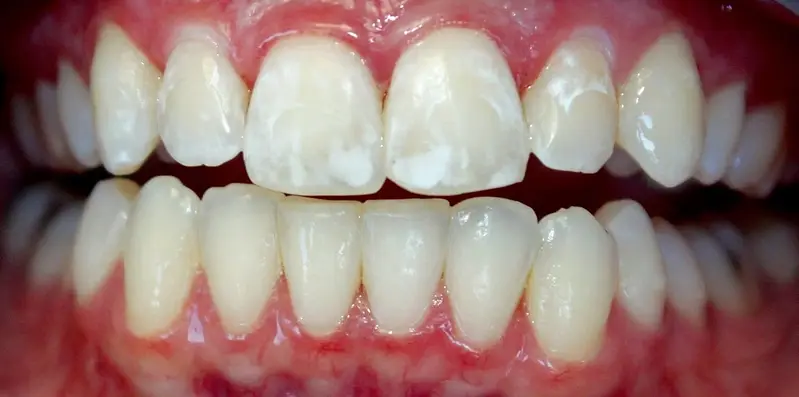 taches blanches sur les dents