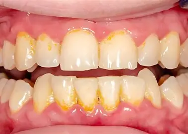 Tartre sur les dents