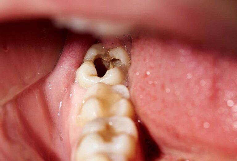 prévention des caries